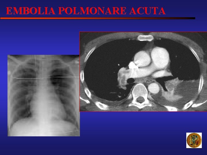 EMBOLIA POLMONARE ACUTA 