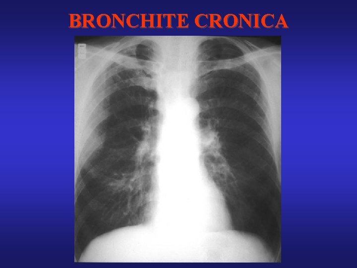 BRONCHITE CRONICA 
