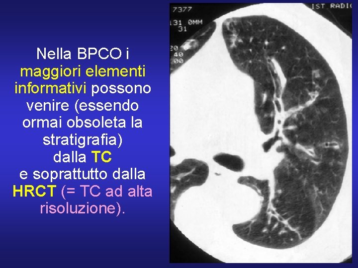 Nella BPCO i maggiori elementi informativi possono venire (essendo ormai obsoleta la stratigrafia) dalla