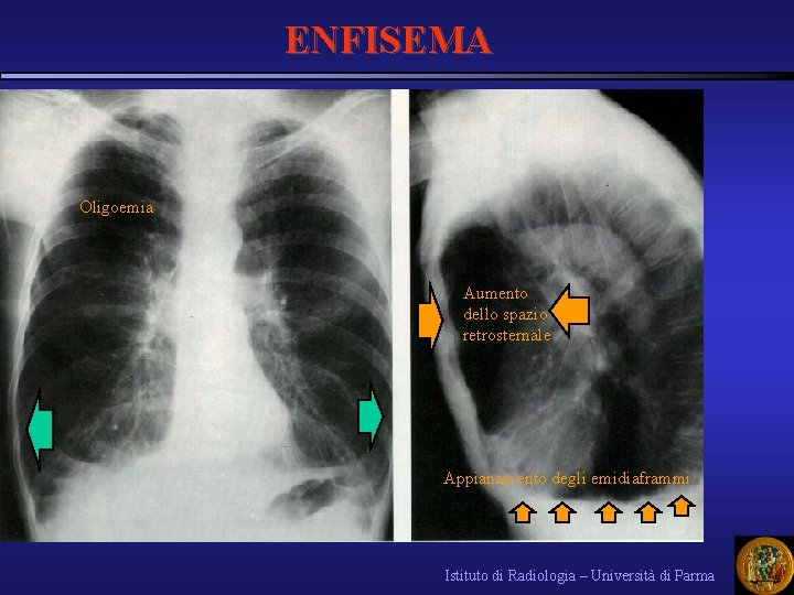 ENFISEMA Oligoemia Aumento dello spazio retrosternale Appianamento degli emidiaframmi Istituto di Radiologia – Università