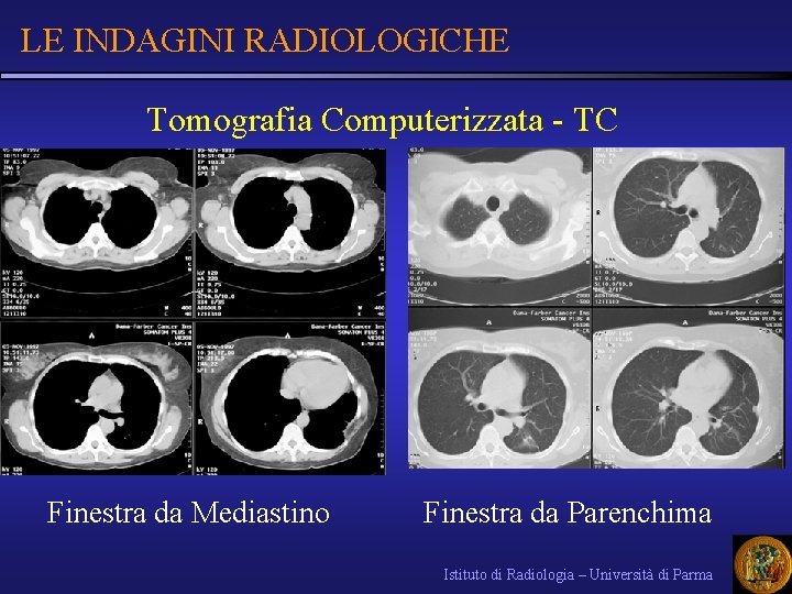 LE INDAGINI RADIOLOGICHE Tomografia Computerizzata - TC Finestra da Mediastino Finestra da Parenchima Istituto