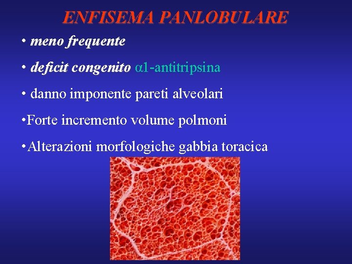 ENFISEMA PANLOBULARE • meno frequente • deficit congenito α 1 -antitripsina • danno imponente
