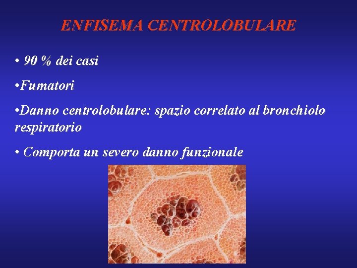 ENFISEMA CENTROLOBULARE • 90 % dei casi • Fumatori • Danno centrolobulare: spazio correlato