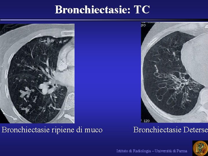 Bronchiectasie: TC Bronchiectasie ripiene di muco Bronchiectasie Deterse Istituto di Radiologia – Università di