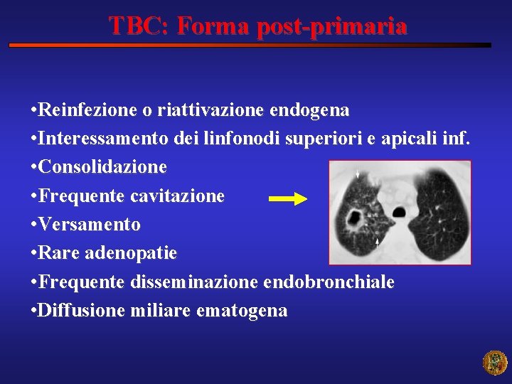 TBC: Forma post-primaria • Reinfezione o riattivazione endogena • Interessamento dei linfonodi superiori e