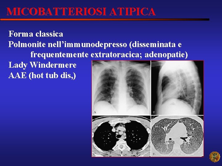 MICOBATTERIOSI ATIPICA Forma classica Polmonite nell’immunodepresso (disseminata e frequentemente extratoracica; adenopatie) Lady Windermere AAE