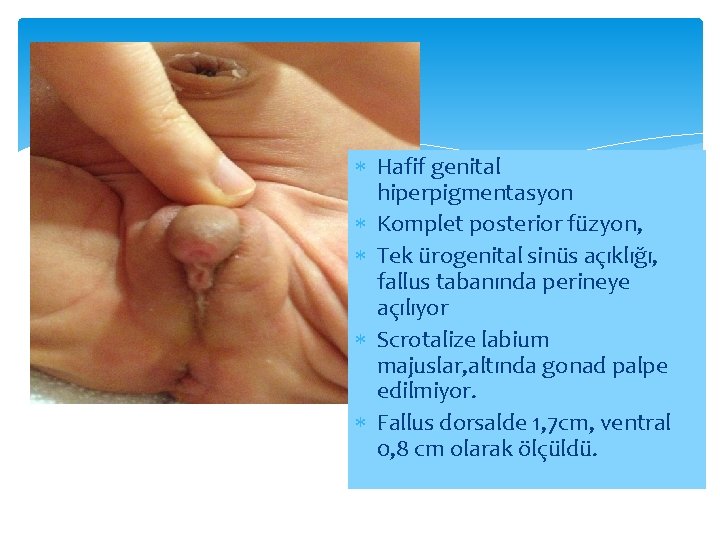 Hafif genital hiperpigmentasyon Komplet posterior füzyon, Tek ürogenital sinüs açıklığı, fallus tabanında perineye Hafif genital hiperpigmentasyon Komplet posterior füzyon, Tek ürogenital sinüs açıklığı, fallus tabanında perineye