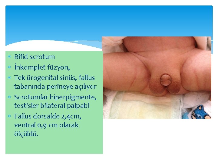  Bifid scrotum İnkomplet füzyon, Tek ürogenital sinüs, fallus tabanında perineye açılıyor Scrotumlar hiperpigmente,