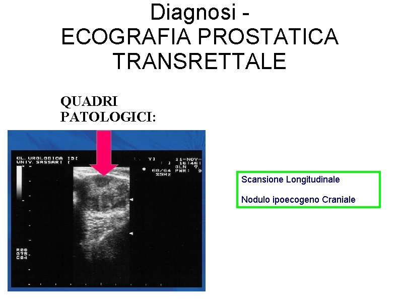Diagnosi ECOGRAFIA PROSTATICA TRANSRETTALE QUADRI PATOLOGICI: Scansione Longitudinale Nodulo ipoecogeno Craniale 