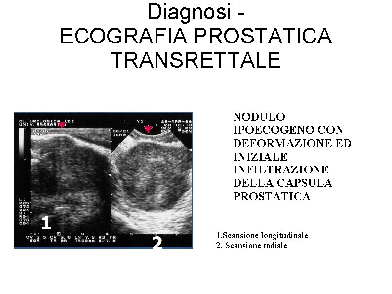 area ipoecogena prostatica