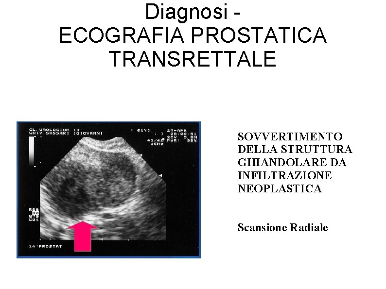 Diagnosi ECOGRAFIA PROSTATICA TRANSRETTALE SOVVERTIMENTO DELLA STRUTTURA GHIANDOLARE DA INFILTRAZIONE NEOPLASTICA Scansione Radiale 