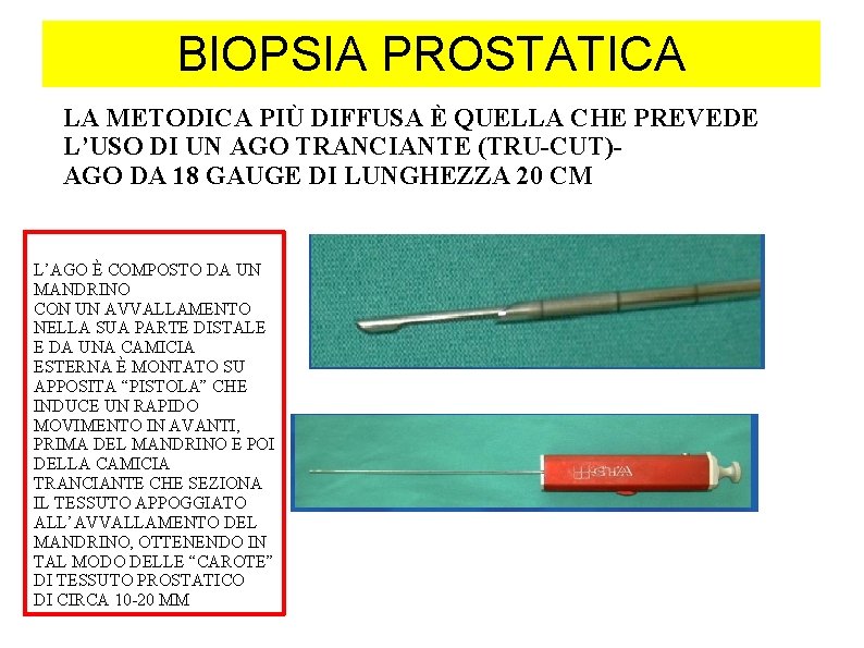 BIOPSIA PROSTATICA LA METODICA PIÙ DIFFUSA È QUELLA CHE PREVEDE L’USO DI UN AGO