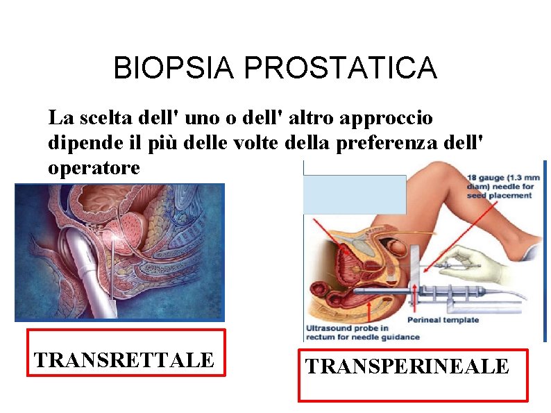 BIOPSIA PROSTATICA La scelta dell' uno o dell' altro approccio dipende il più delle