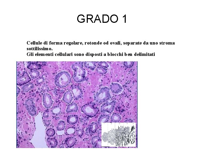 GRADO 1 Cellule di forma regolare, rotonde od ovali, separate da uno stroma sottilissimo.