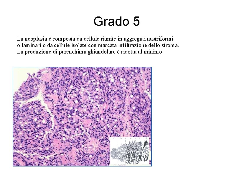 Grado 5 La neoplasia è composta da cellule riunite in aggregati nastriformi o laminari