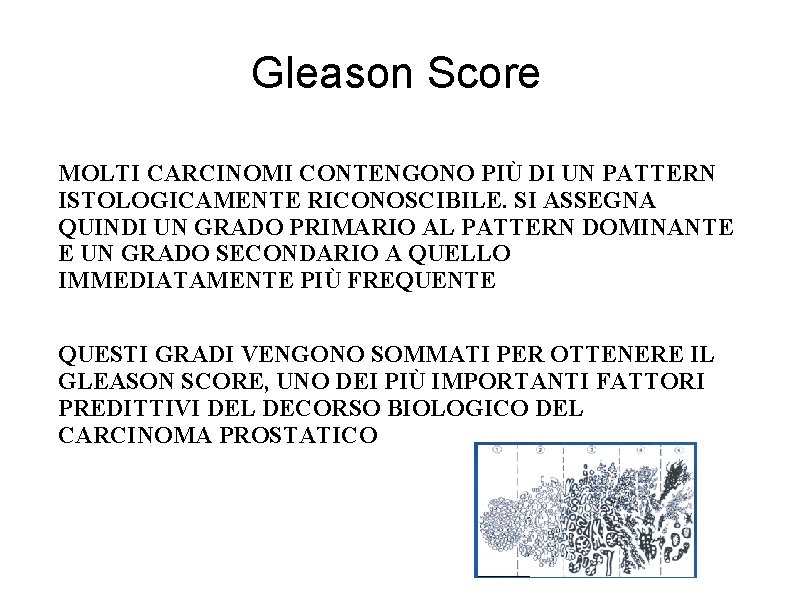 Gleason Score MOLTI CARCINOMI CONTENGONO PIÙ DI UN PATTERN ISTOLOGICAMENTE RICONOSCIBILE. SI ASSEGNA QUINDI