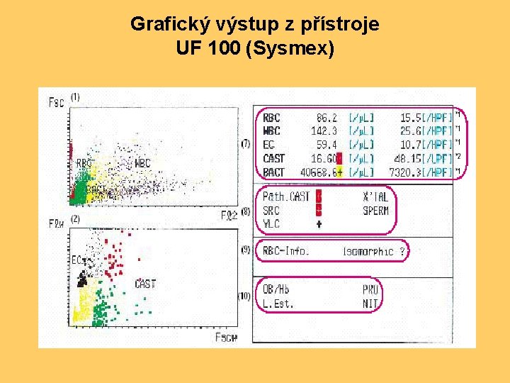 Grafický výstup z přístroje UF 100 (Sysmex) 