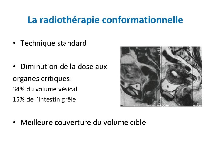 La radiothérapie conformationnelle • Technique standard • Diminution de la dose aux organes critiques: