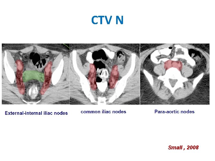 CTV N Small , 2008 