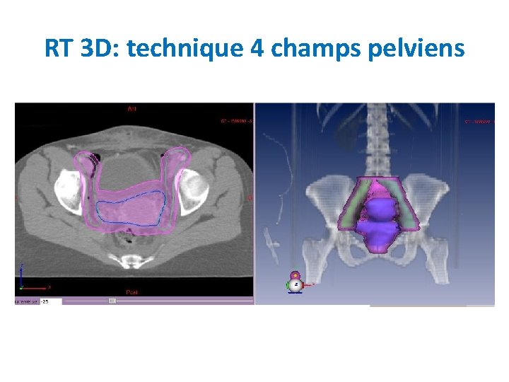 RT 3 D: technique 4 champs pelviens 