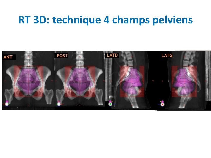 RT 3 D: technique 4 champs pelviens 