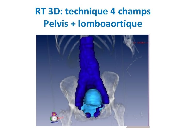 RT 3 D: technique 4 champs Pelvis + lomboaortique 