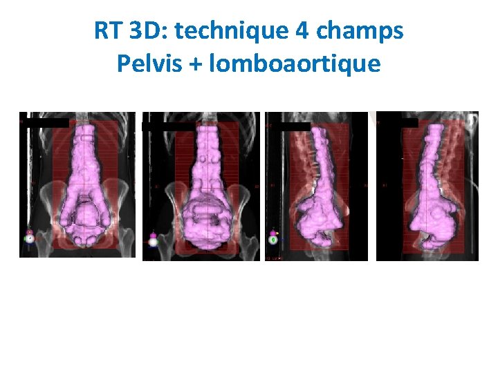 RT 3 D: technique 4 champs Pelvis + lomboaortique 