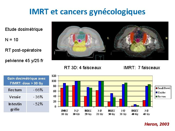 IMRT et cancers gynécologiques Etude dosimétrique N = 10 RT post-opératoire pelvienne 45 y/25