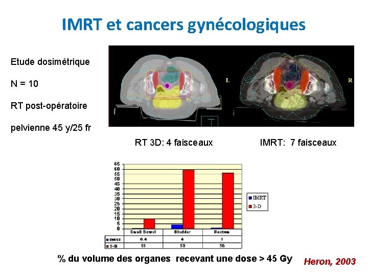 IMRT et cancers gynécologiques Etude dosimétrique N = 10 RT post-opératoire pelvienne 45 y/25