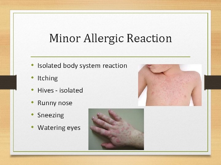 Minor Allergic Reaction • • • Isolated body system reaction Itching Hives - isolated