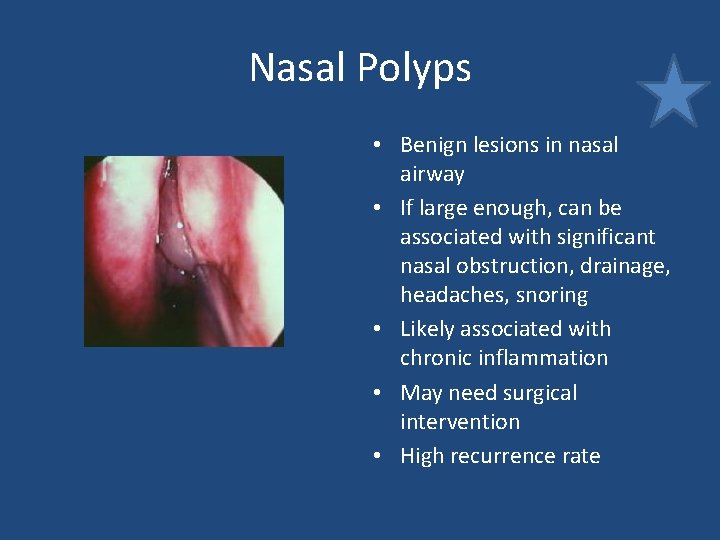 Nasal Polyps • Benign lesions in nasal airway • If large enough, can be Nasal Polyps • Benign lesions in nasal airway • If large enough, can be