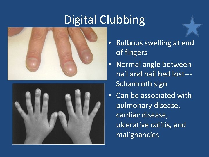 Digital Clubbing • Bulbous swelling at end of fingers • Normal angle between nail Digital Clubbing • Bulbous swelling at end of fingers • Normal angle between nail