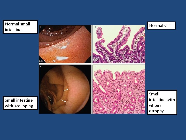 Normal small intestine Normal villi Small intestine with scalloping Small intestine with villous atrophy Normal small intestine Normal villi Small intestine with scalloping Small intestine with villous atrophy