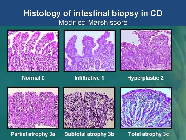 Histology of intestinal biopsy in CD Modified Marsh score Histology of intestinal biopsy in CD Modified Marsh score