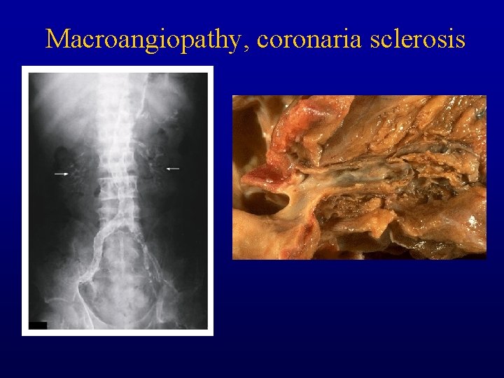 Macroangiopathy, coronaria sclerosis 