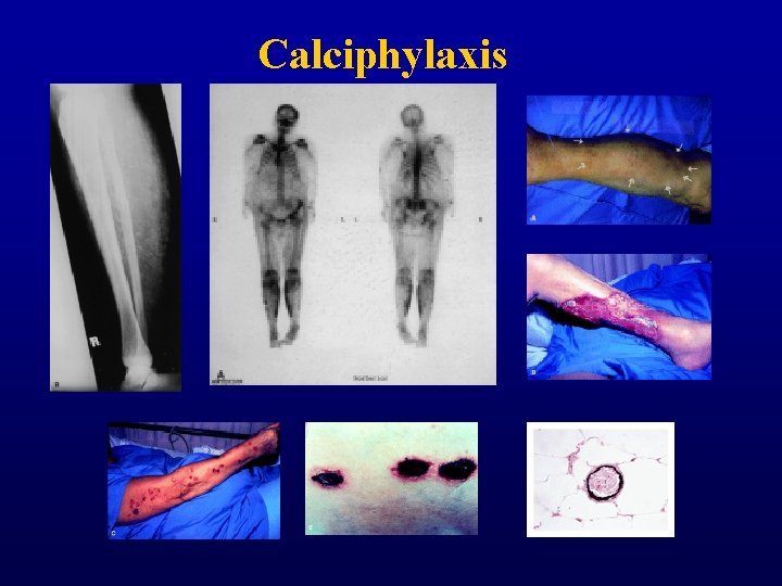Calciphylaxis Calciphylaxis
