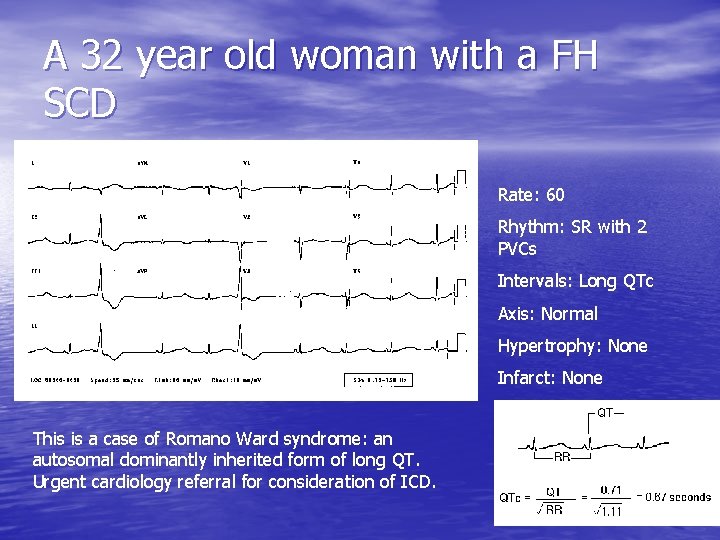 A 32 year old woman with a FH SCD Rate: 60 Rhythm: SR with