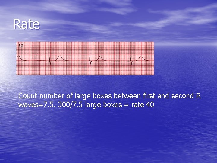 Rate Count number of large boxes between first and second R waves=7. 5. 300/7.