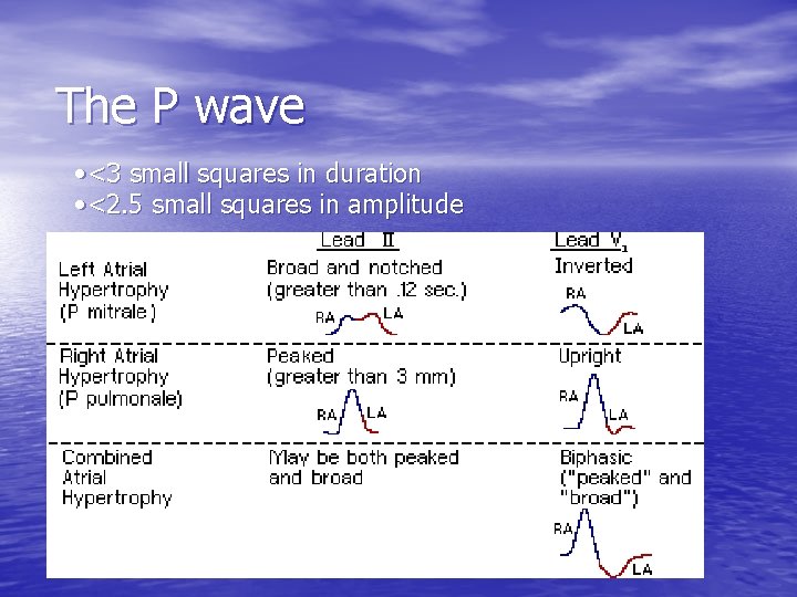 The P wave • <3 small squares in duration • <2. 5 small squares