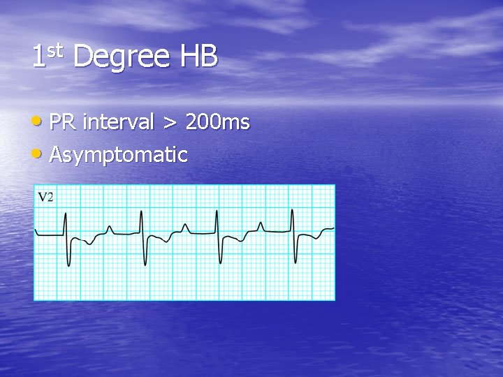 1 st Degree HB • PR interval > 200 ms • Asymptomatic 