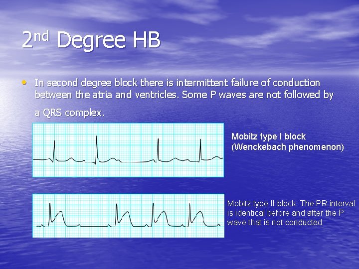 2 nd Degree HB • In second degree block there is intermittent failure of