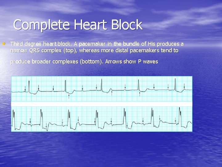 Complete Heart Block • Third degree heart block. A pacemaker in the bundle of
