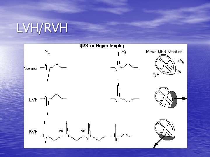 LVH/RVH 