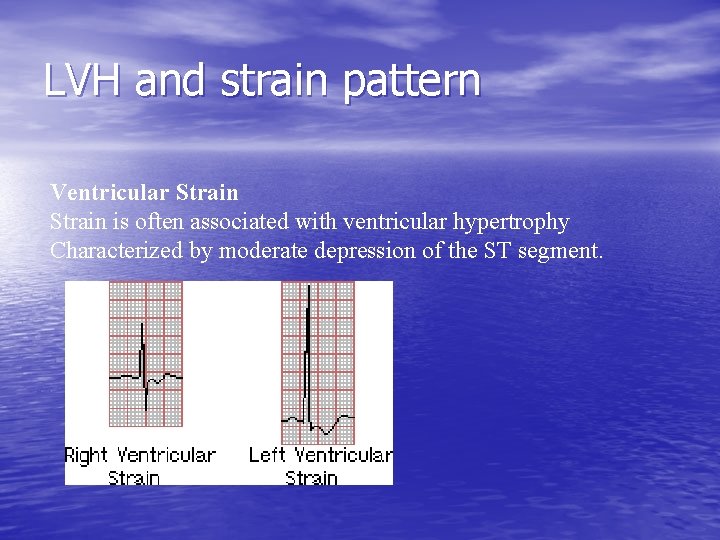 LVH and strain pattern Ventricular Strain is often associated with ventricular hypertrophy Characterized by