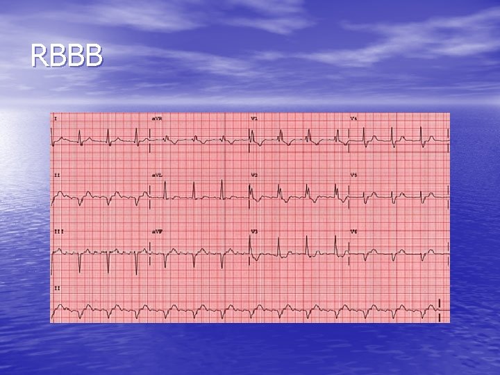 RBBB 