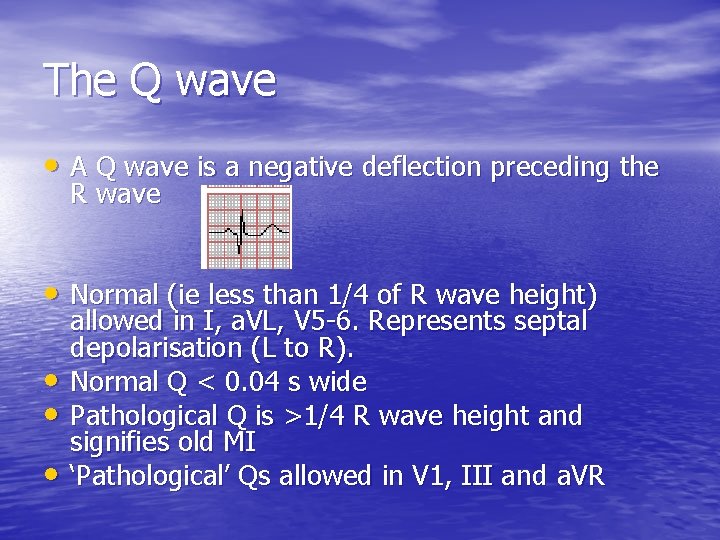 The Q wave • A Q wave is a negative deflection preceding the R