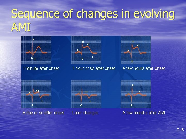 Sequence of changes in evolving AMI R R T R ST ST P P