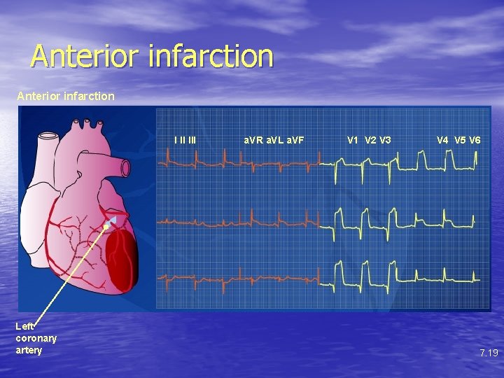 Anterior infarction I II III Left coronary artery a. VR a. VL a. VF