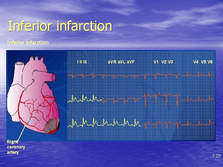 Inferior infarction I II III Right coronary artery a. VR a. VL a. VF