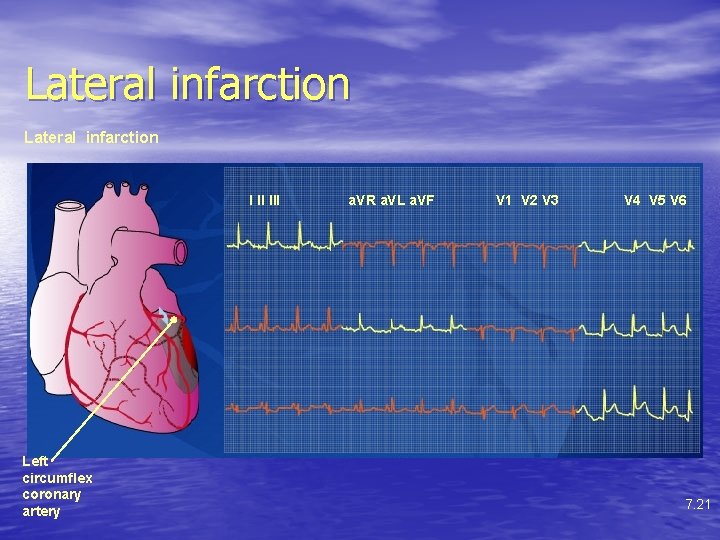 Lateral infarction I II III Left circumflex coronary artery a. VR a. VL a.